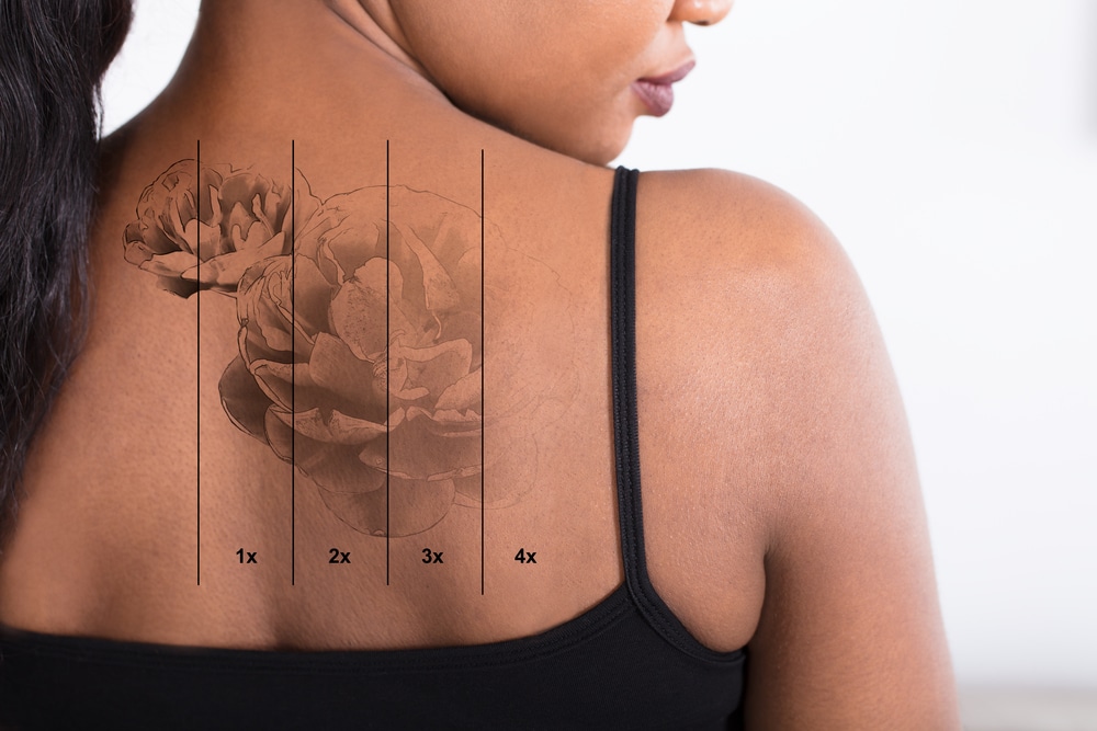 Close-up,Of,A,Laser,Tattoo,Removal,On,Woman's,Back
